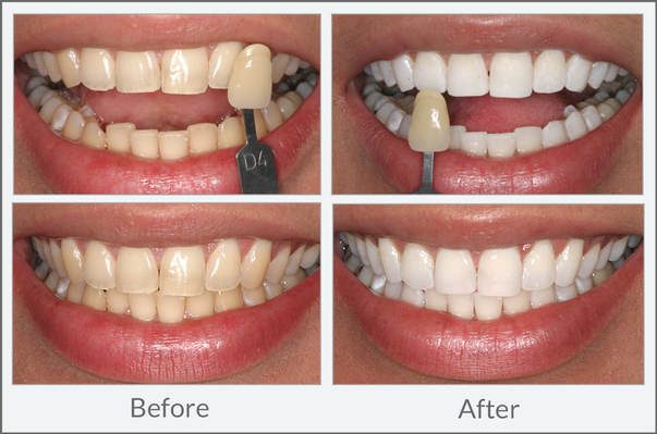 Teeth Whitening Services in Boca Raton: What Dentists Should Understand About Lab-Fabricated Shade Matching