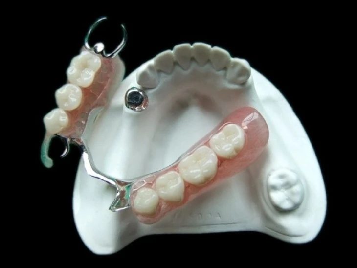 A plaster dental model displaying two removable partial dentures with pink acrylic, artificial teeth, and metal clasps.